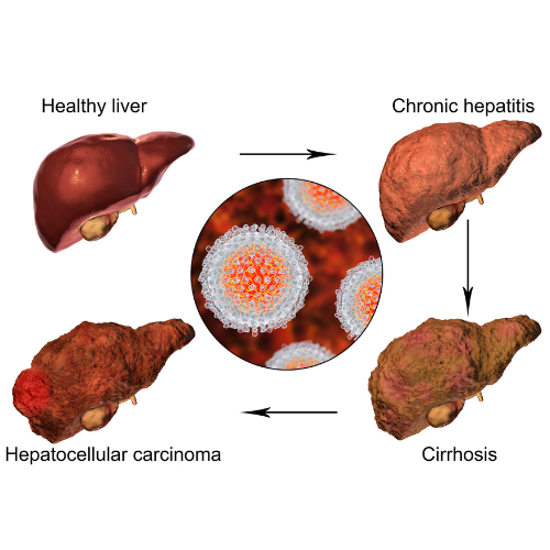 chronic liver disease chronic liver disease