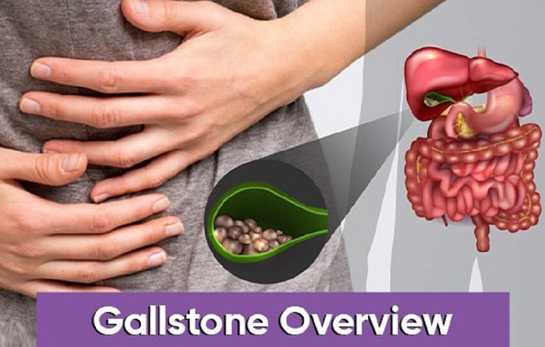 Gallstone Overview