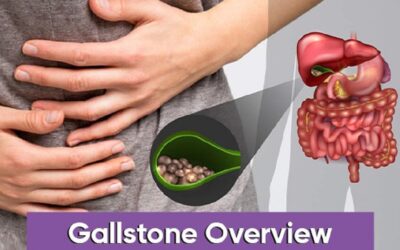 Gallstone Overview