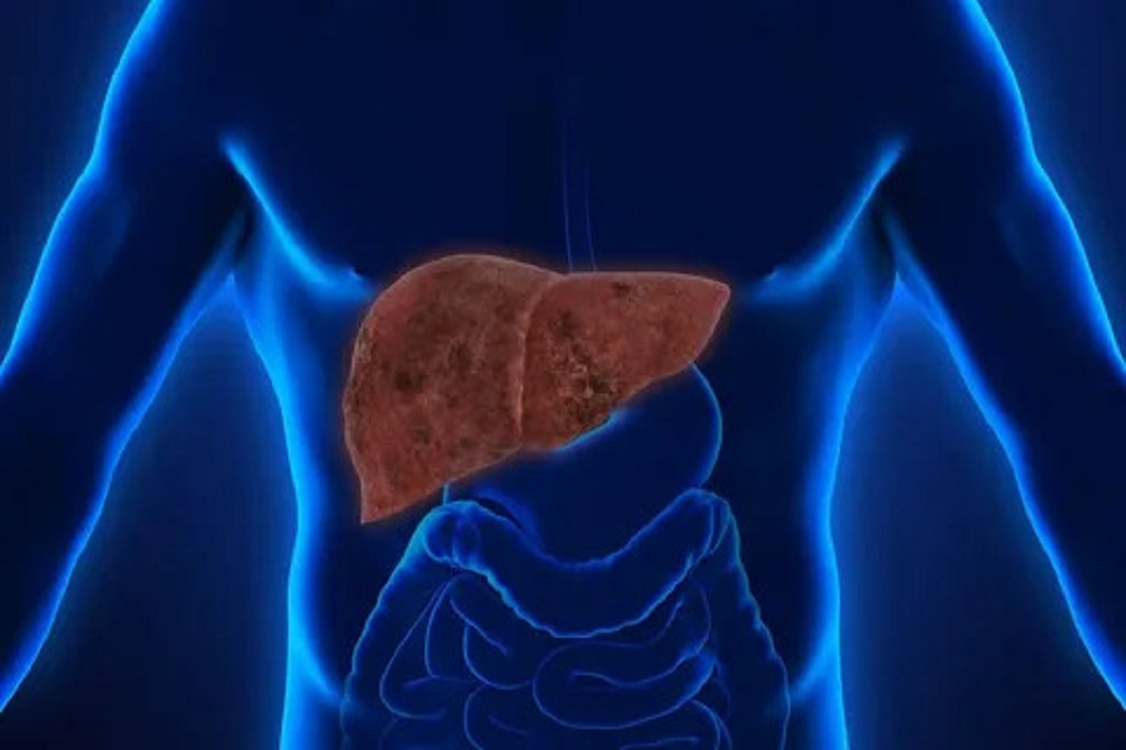 hepatic-steatosis-what-is-it-causes-diagnosis-treatment-and-more